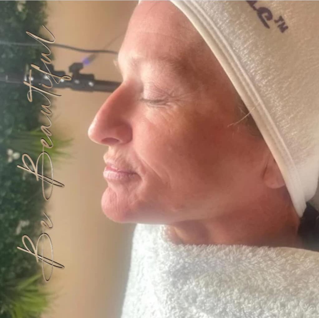before and after collagen lift be beautiful torbay 1
