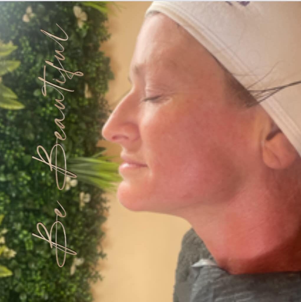before and after collagen lift be beautiful torbay 2