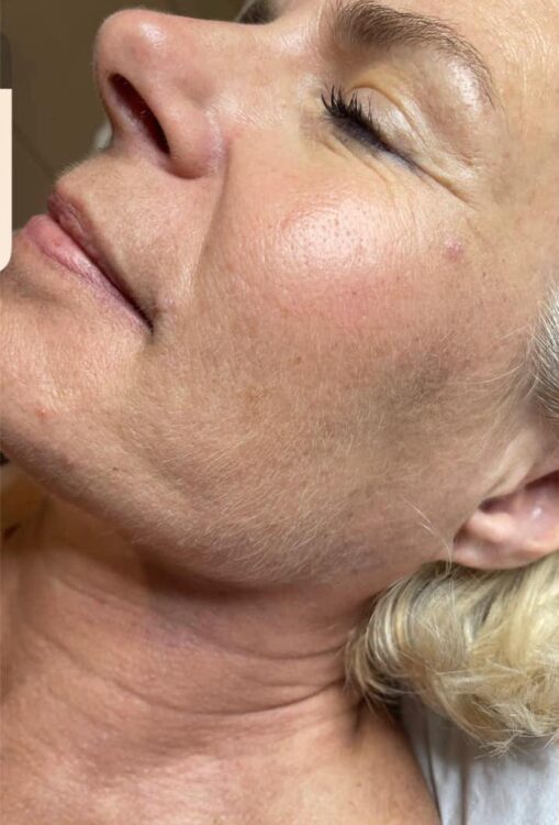 before and after collagen lift beauty by joanne 1