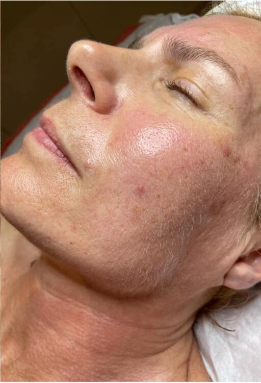 before and after collagen lift beauty by joanne 2