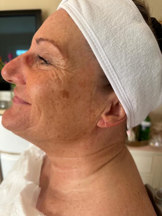 before and after collagen lift beauty haven 1