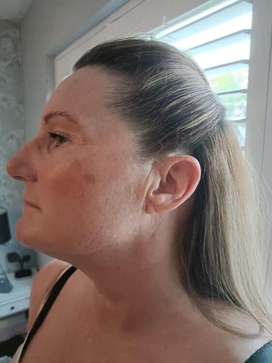 before and after collagen lift beauty haven 2