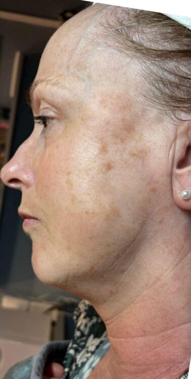 before and after collagen lift becky's beauty and holistics 1