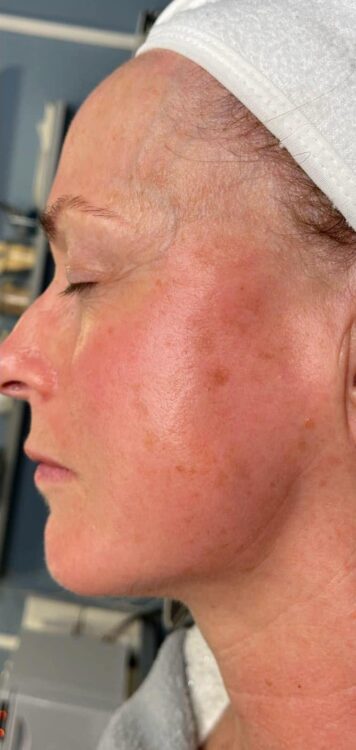 before and after collagen lift becky's beauty and holistics 2