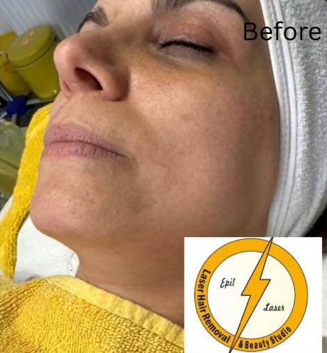 before and after collagen lift depilaser 1