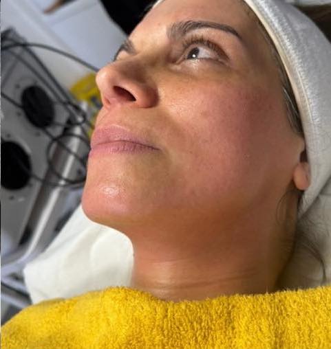before and after collagen lift depilaser 2