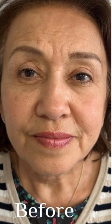 before and after collagen lift epilaser 1