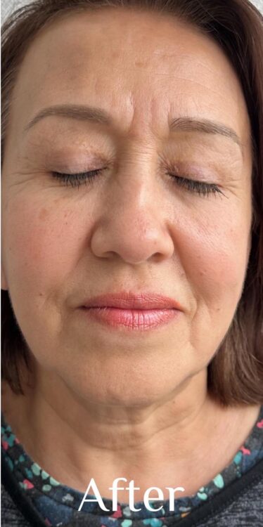 before and after collagen lift epilaser 2