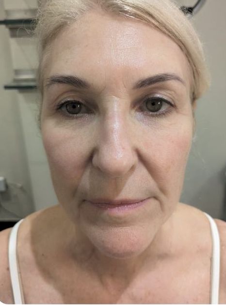 before and after collagen lift hada aesthetics 1