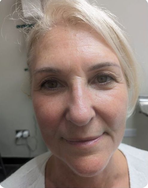 before and after collagen lift hada aesthetics 2