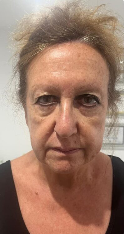 before and after collagen lift holmes aesthetics 1
