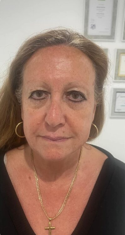 before and after collagen lift holmes aesthetics 2