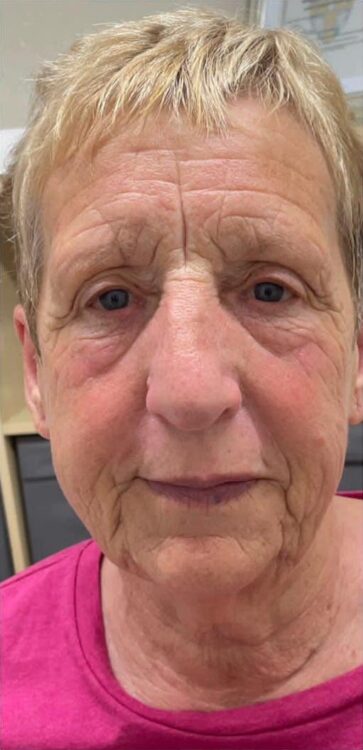 before and after collagen lift if looks could kill 1