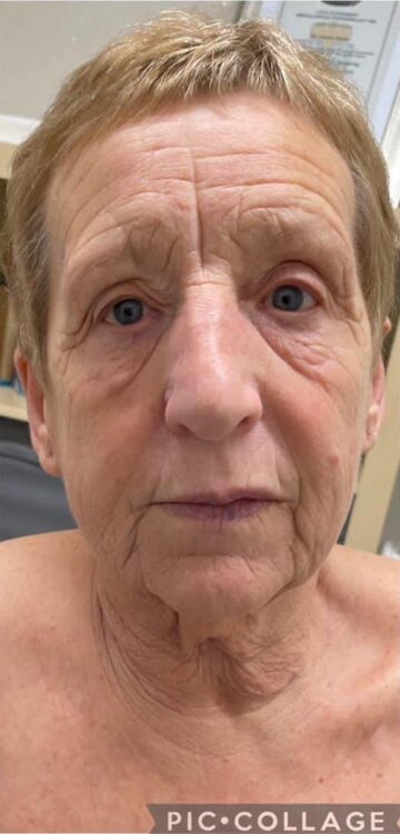 before and after collagen lift if looks could kill 1