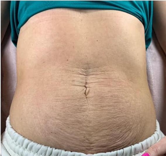 before and after collagen lift jojos beauty 1