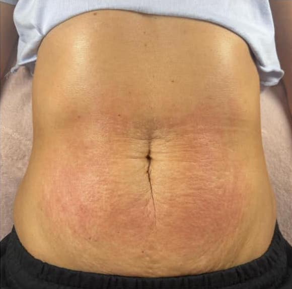 before and after collagen lift jojos beauty 2