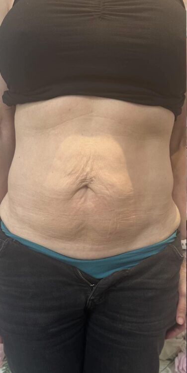 before and after collagen lift katherine monique beauty 1