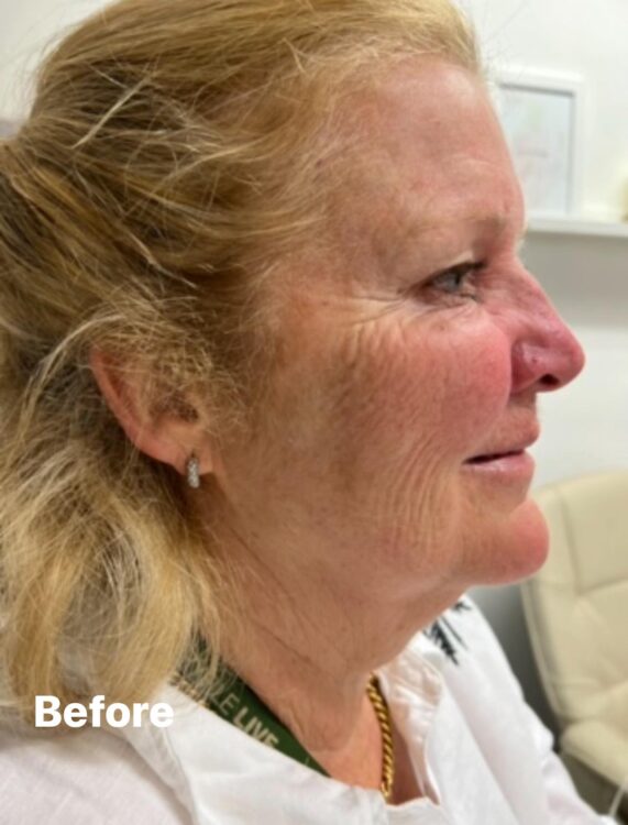 before and after collagen lift lauren ann beauty therapy 1