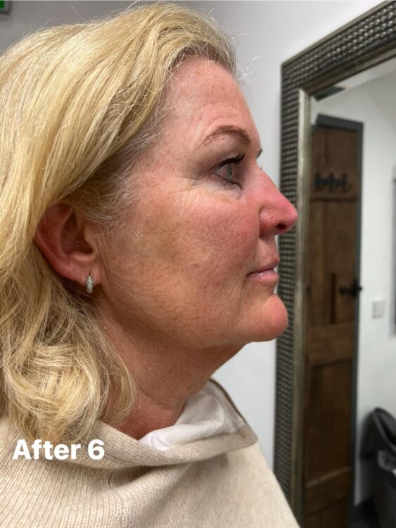 before and after collagen lift lauren ann beauty therapy 2