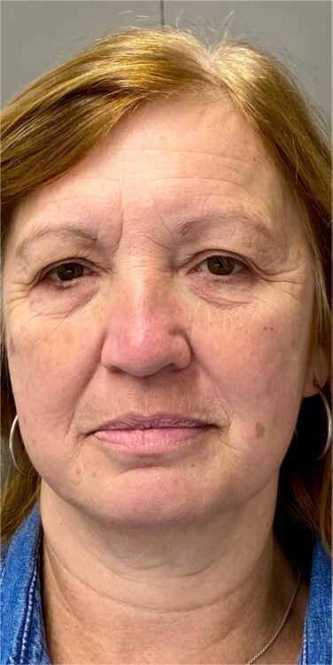 before and after collagen lift lotus beauty 1