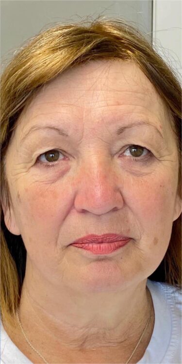 before and after collagen lift lotus beauty 2