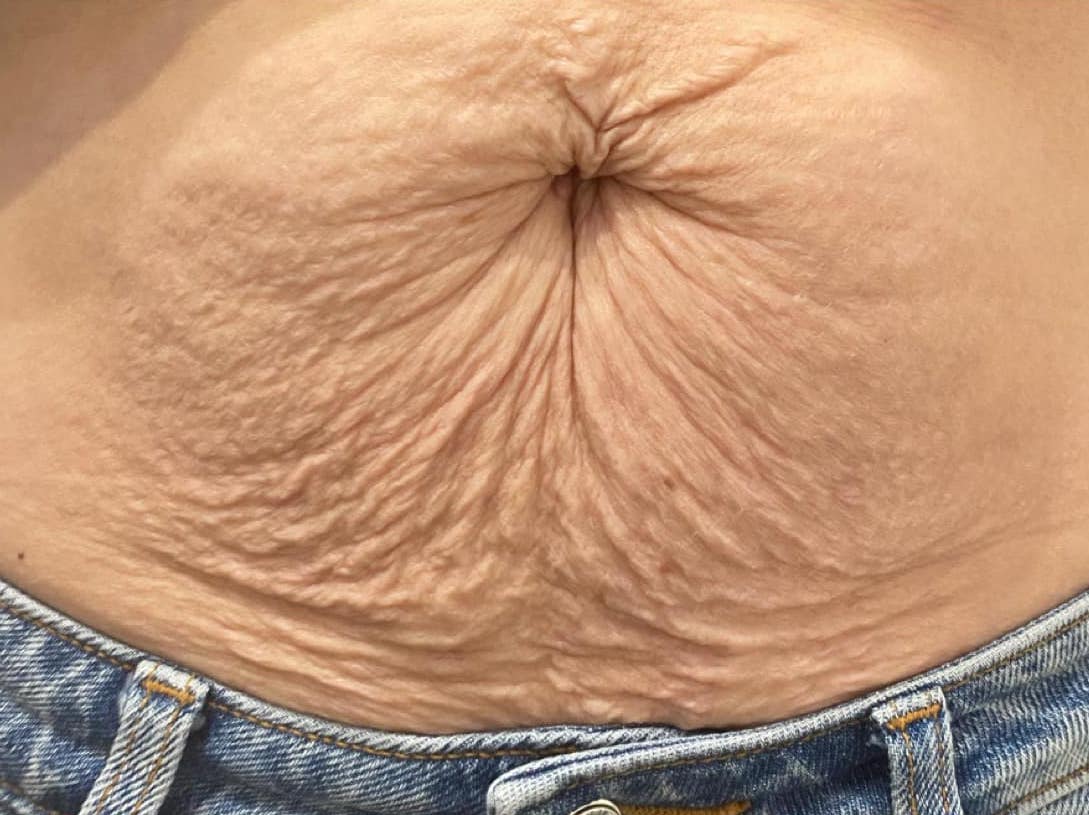 before and after collagen lift natural beauty by natalie 1