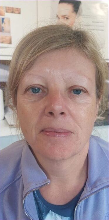 before and after collagen lift perry's beauty 1