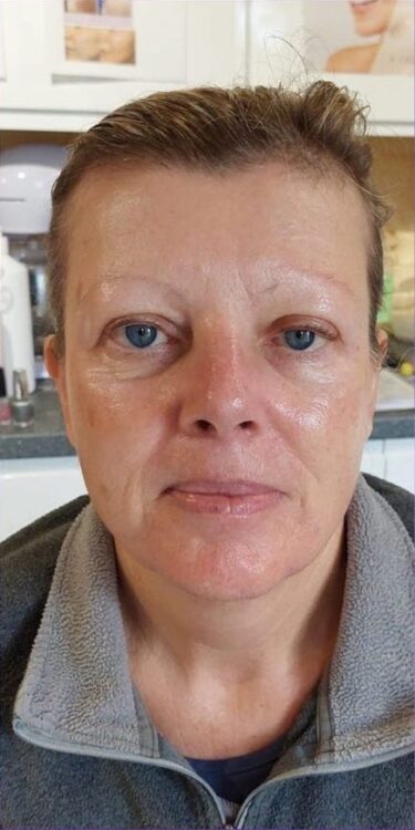 before and after collagen lift perry's beauty 2
