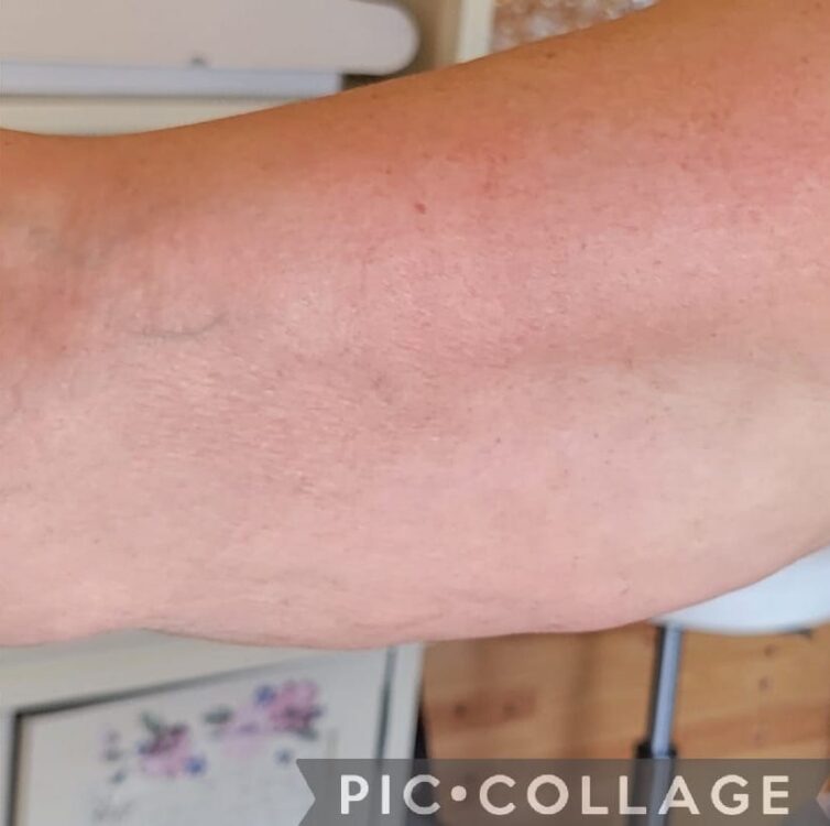 before and after collagen lift personalised hair and beauty 2