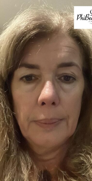 before and after collagen lift phibeauty uk 1
