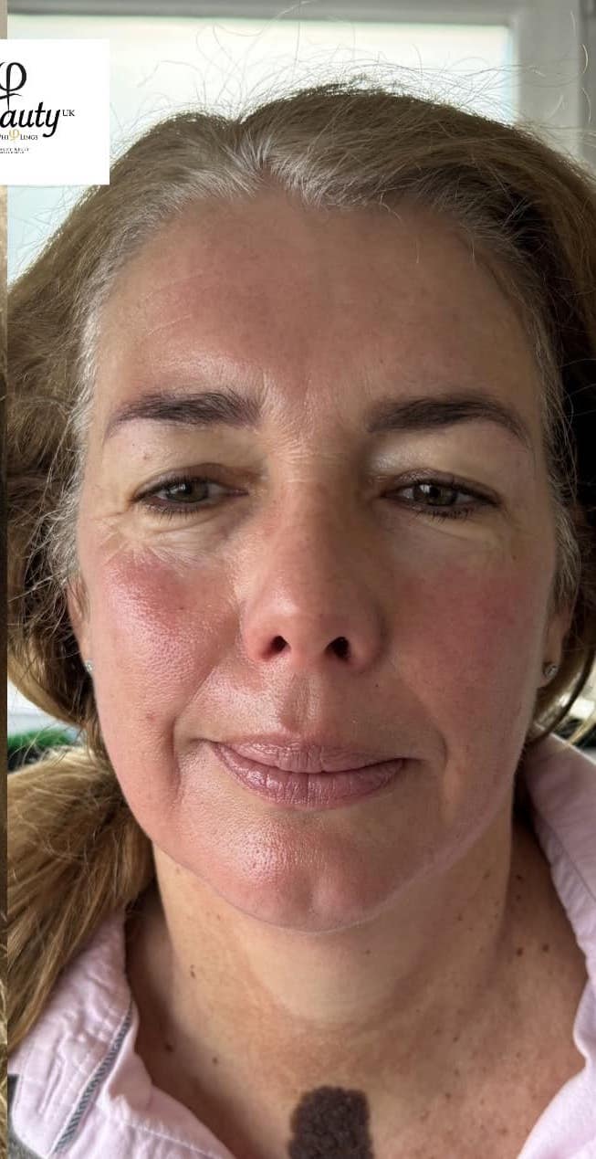 before and after collagen lift phibeauty uk 2