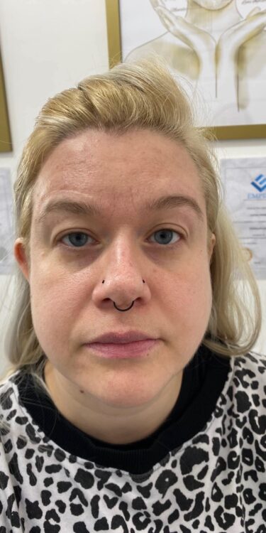 before and after collagen lift salon symphony 1