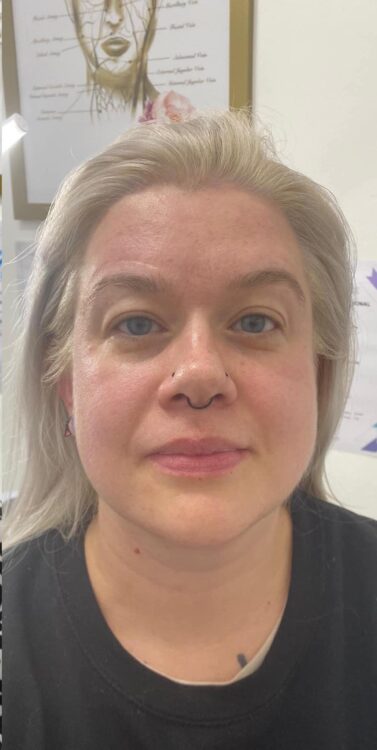 before and after collagen lift salon symphony 2