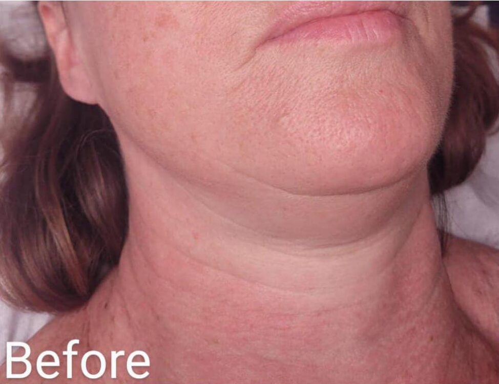 before and after collagen lift the beauty rooms 1