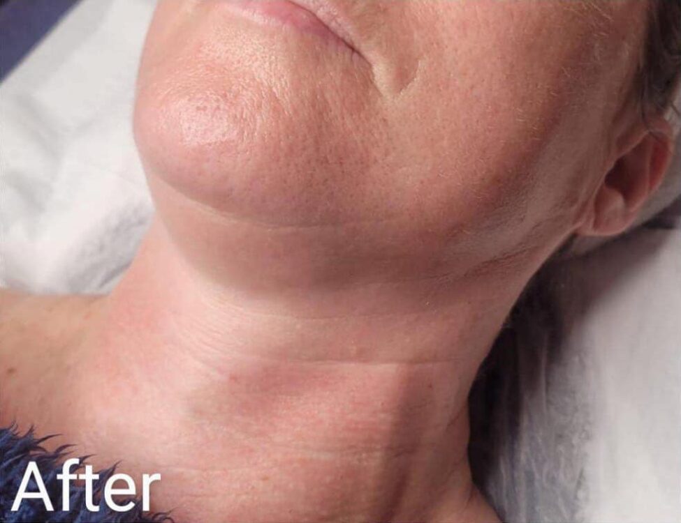 before and after collagen lift the beauty rooms 2