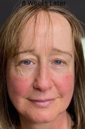 before and after collagen lift tranquility lash and beauty 2