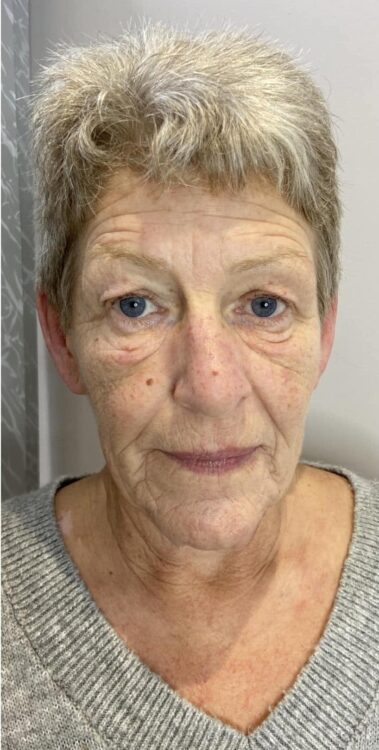 before and after collagen lift ultimate beauty and elegance by renu 1