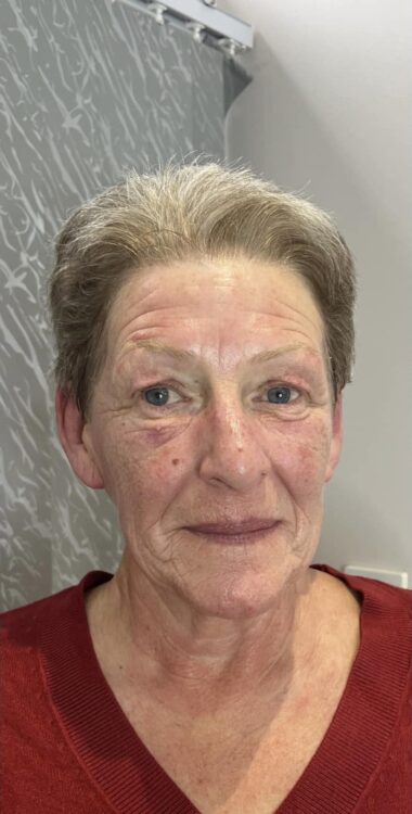 before and after collagen lift ultimate beauty and elegance by renu 2