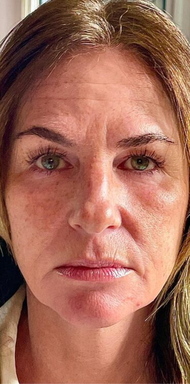 before and after collagen lift ultimate bijou beauty room 1