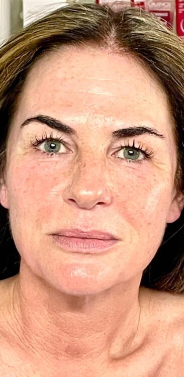 before and after collagen lift ultimate bijou beauty room 2