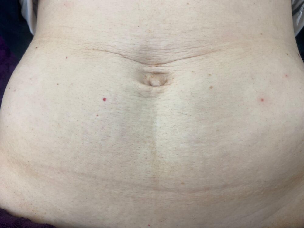 before and after collagen lift ultimate lauren's beauty and massage 1