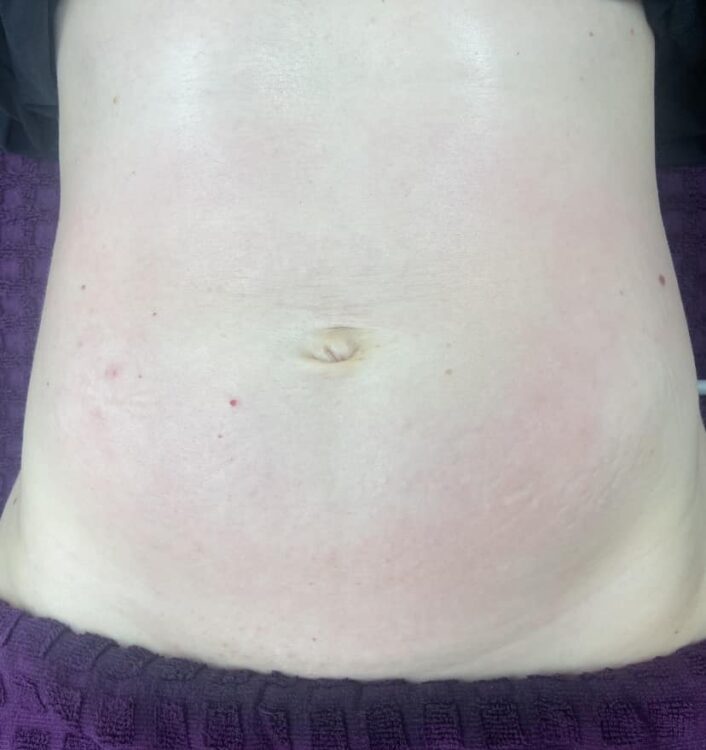 before and after collagen lift ultimate lauren's beauty and massage 2