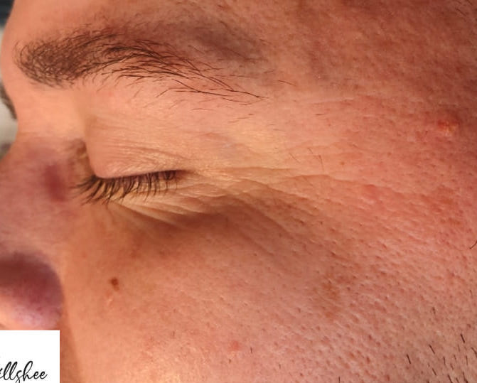 before and after collagen lift ultimate rebecca willshee skin specialist 1