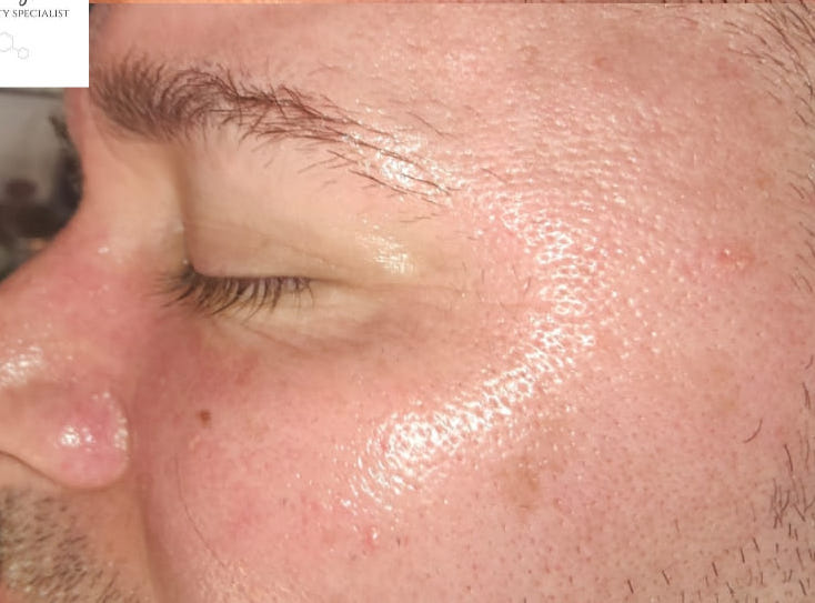 before and after collagen lift ultimate rebecca willshee skin specialist 2