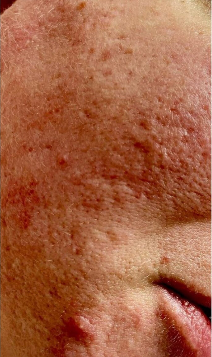 before and after ipl acne bijou beauty room 1