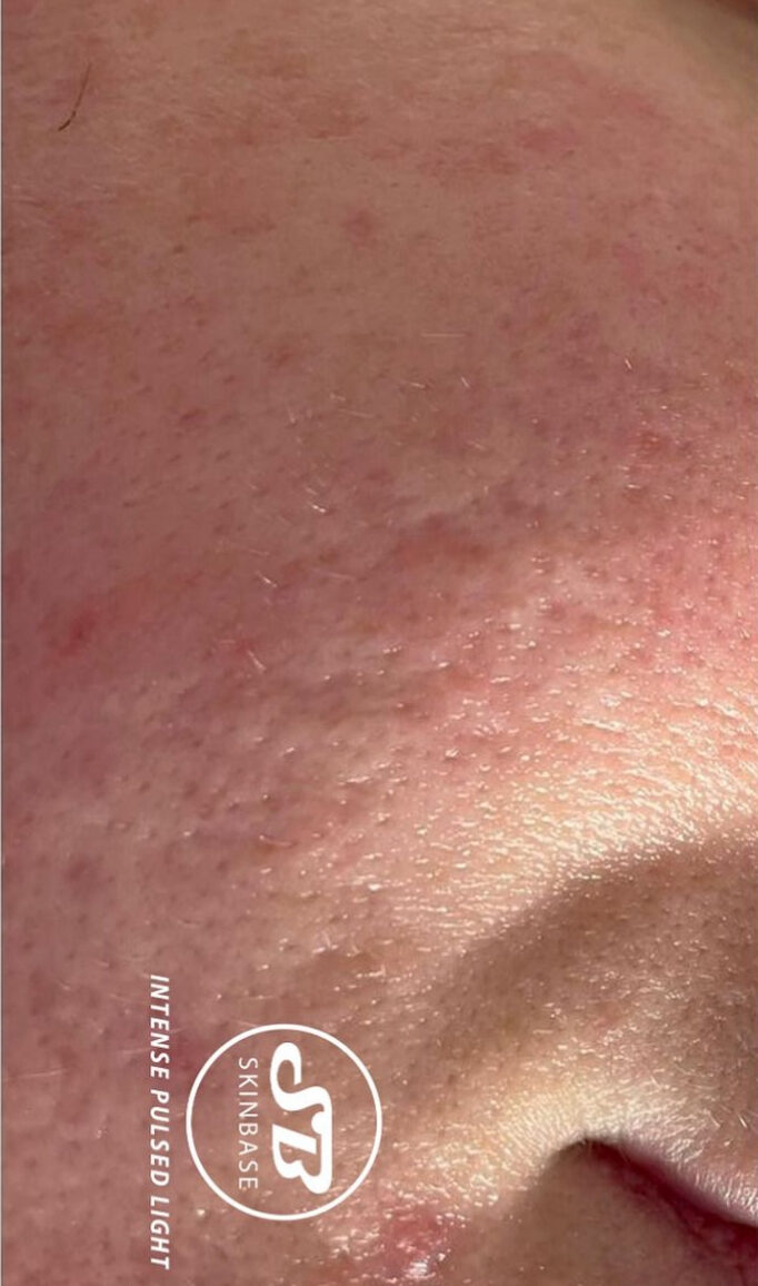 before and after ipl acne bijou beauty room 2