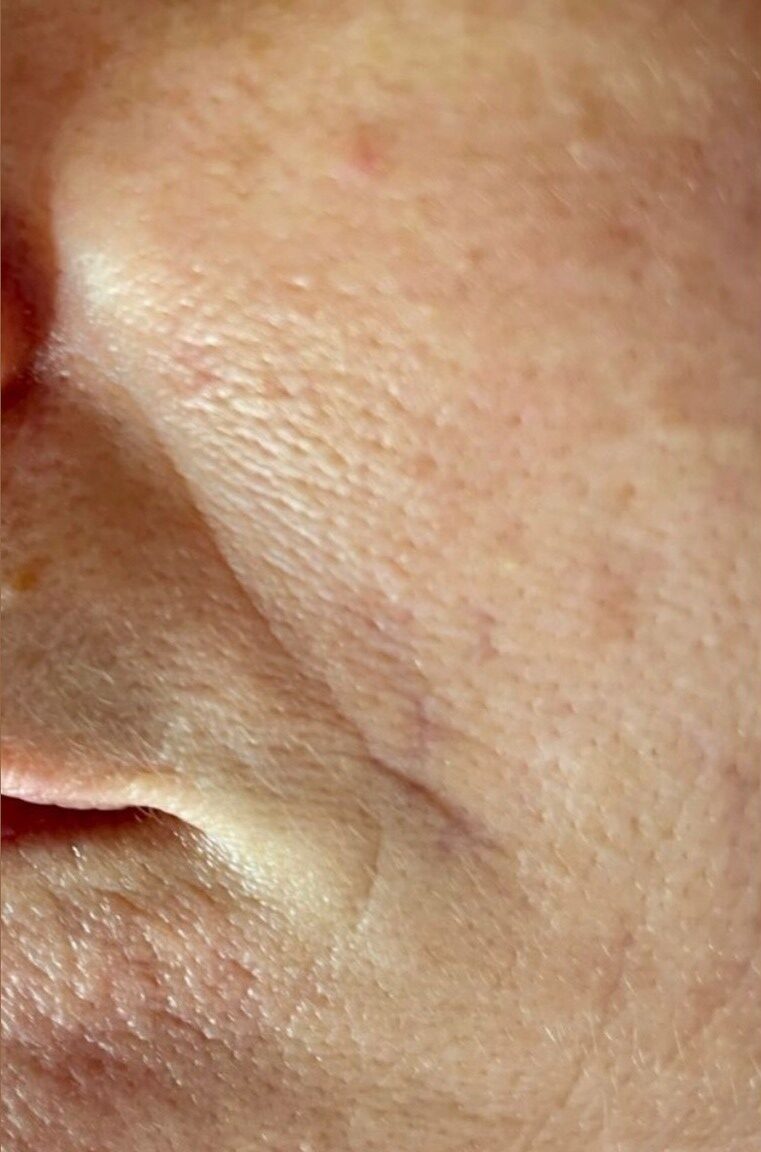 before and after ipl rejuvenation 2 bijou beauty room 1