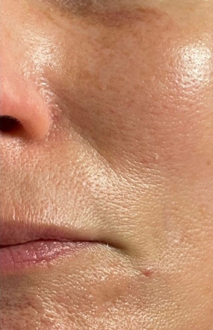 before and after ipl rejuvenation 2 bijou beauty room 2