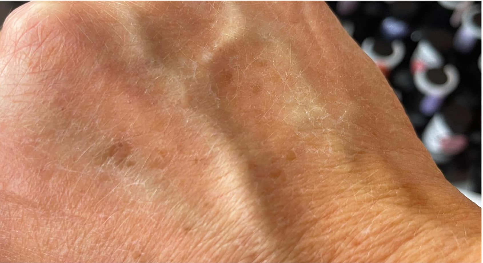 before and after ipl rejuvenation bijou beauty room 1