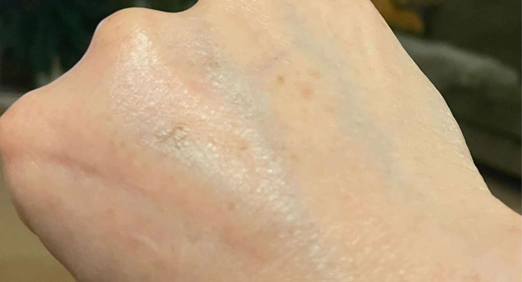 before and after ipl rejuvenation bijou beauty room 2
